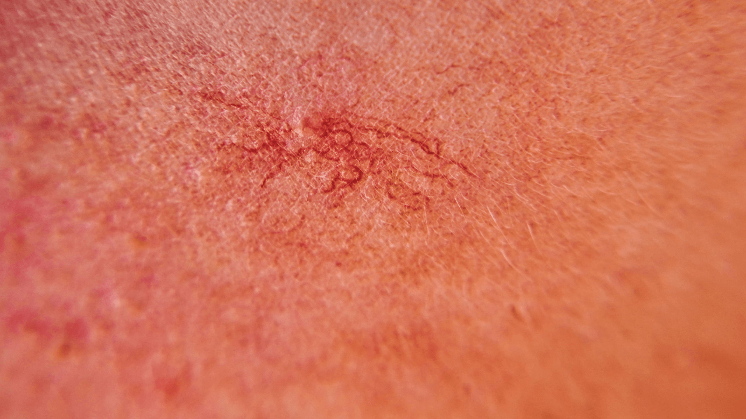 Facial thread veins and broken capillaries on the cheek