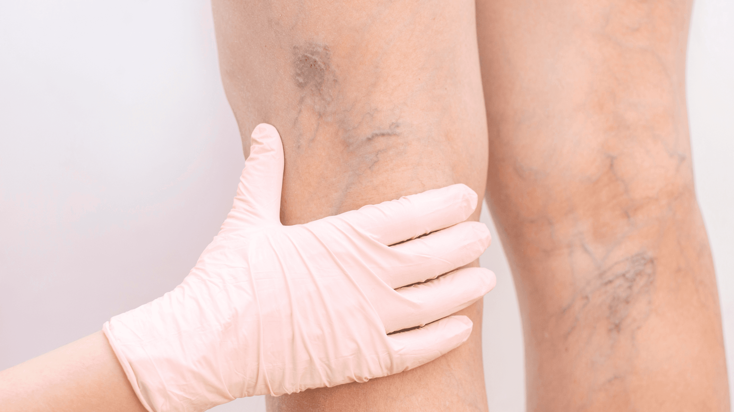 Thread veins (spider veins) behind the knee on the leg